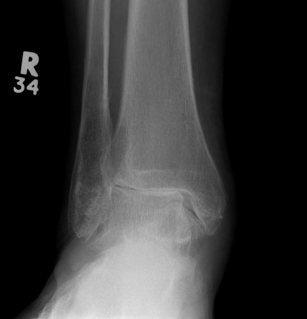 Ankle OA Pre Arthroplasty